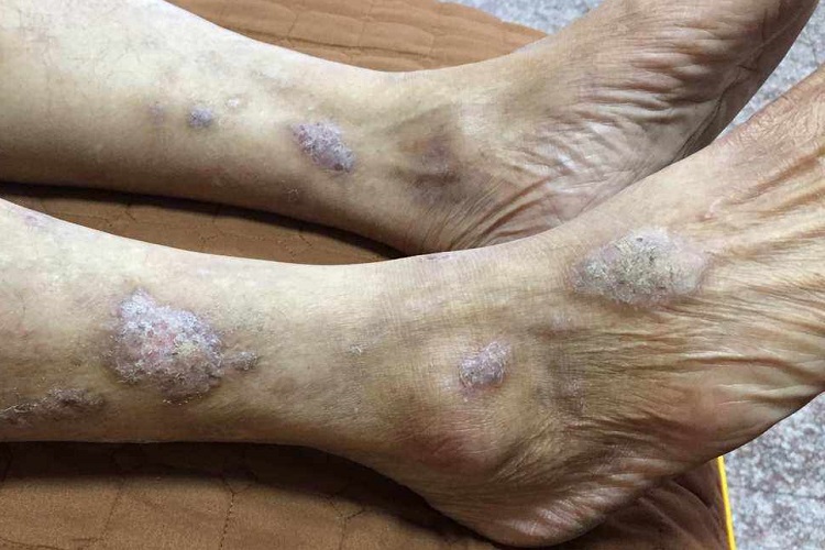 症状性苔藓样疹脚背症状图