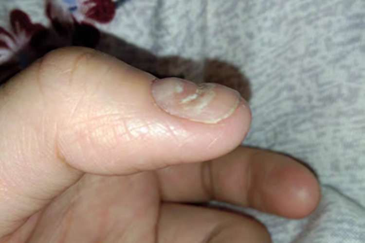 近端甲下型甲真菌病手指甲症状图