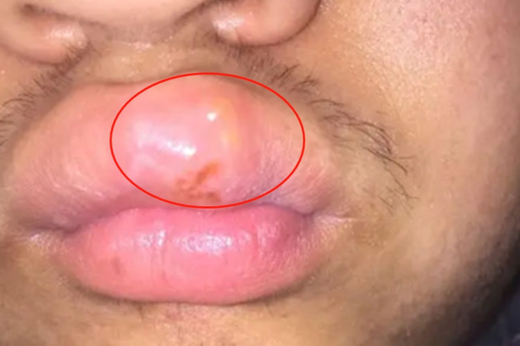梅毒性唇下疳嘴唇水疱图