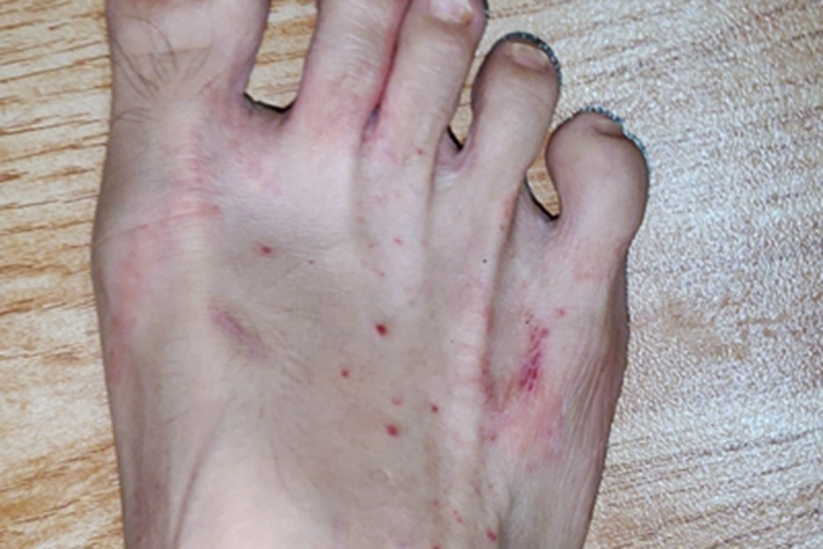 虫咬皮炎脚背血点图