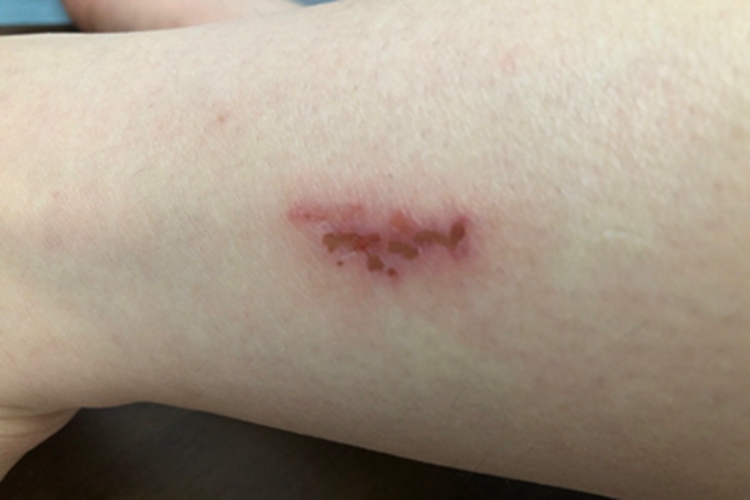 接触性皮炎胳膊症状图