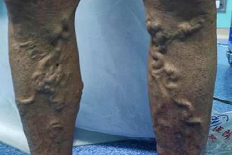 大隐静脉曲张小腿静脉粗大疙瘩图