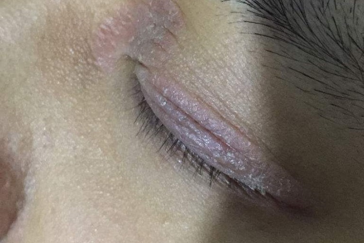 鳞屑性睑缘炎症状图 鳞屑性睑缘炎症状图