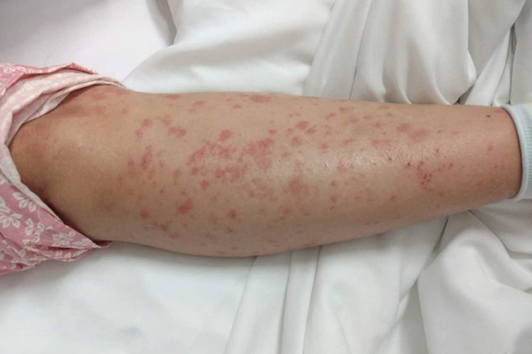 梅毒小腿丘疹性梅毒疹图