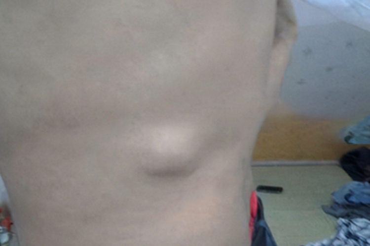 血管脂肪瘤包块图