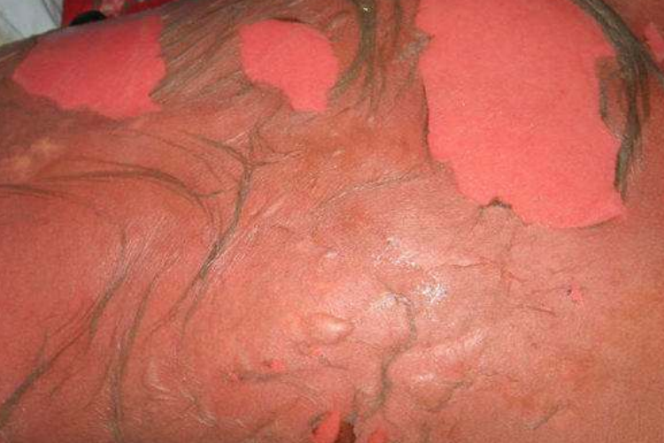 中毒性表皮坏死皮肤剥脱图 中毒性表皮坏死皮肤剥脱图