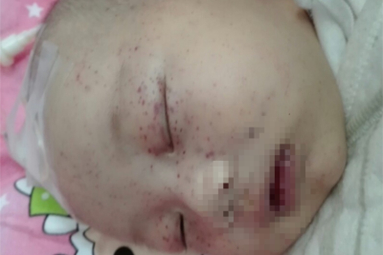 先天性风疹综合征眼周红点图