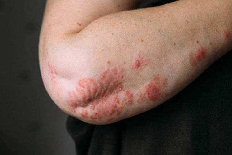 关节病型银屑病肘部症状图