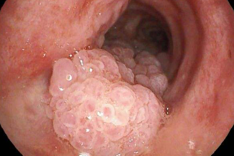 喉乳头状瘤图