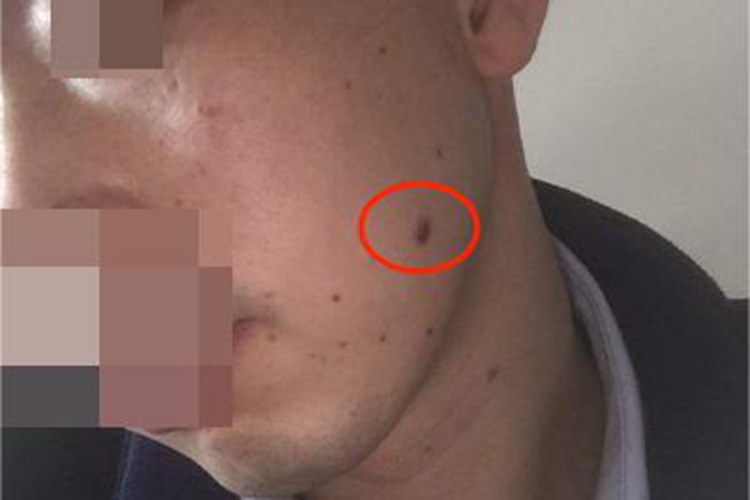 皮内痣面部长斑图