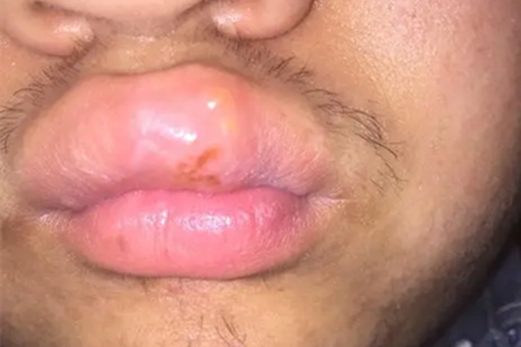 梅毒性唇下疳症状图