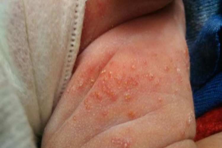 儿童大腿内侧急性湿疹图