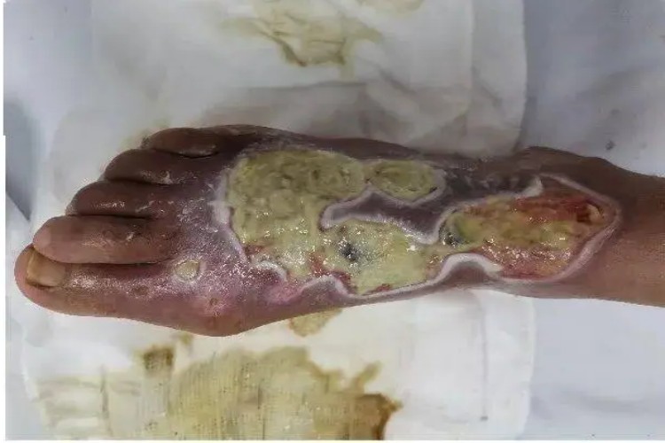 湿性坏疽脚背渗液图