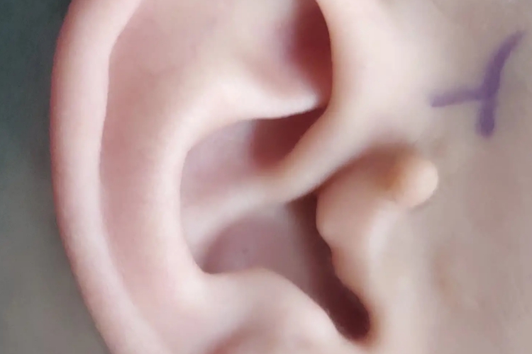 耳朵上长了个肉疙瘩图