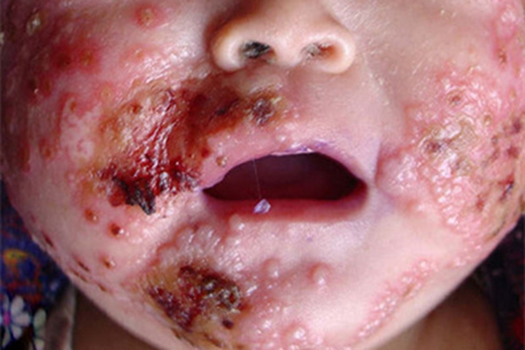 卡波西水痘样疹面部水疱图