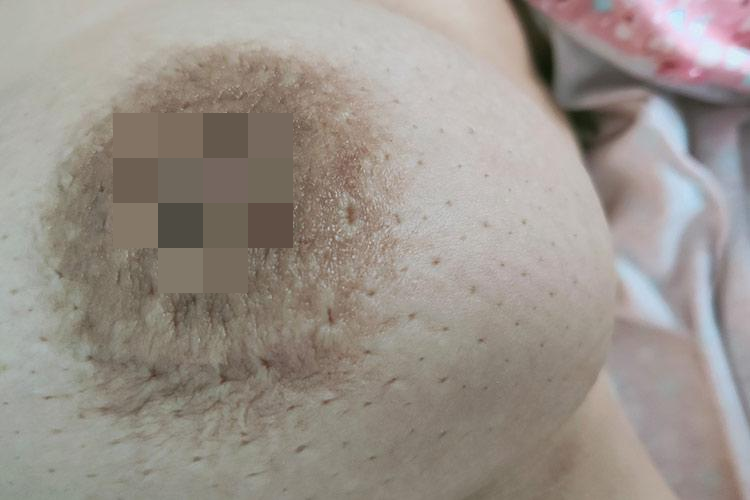 乳房肿块图 乳房肿块图