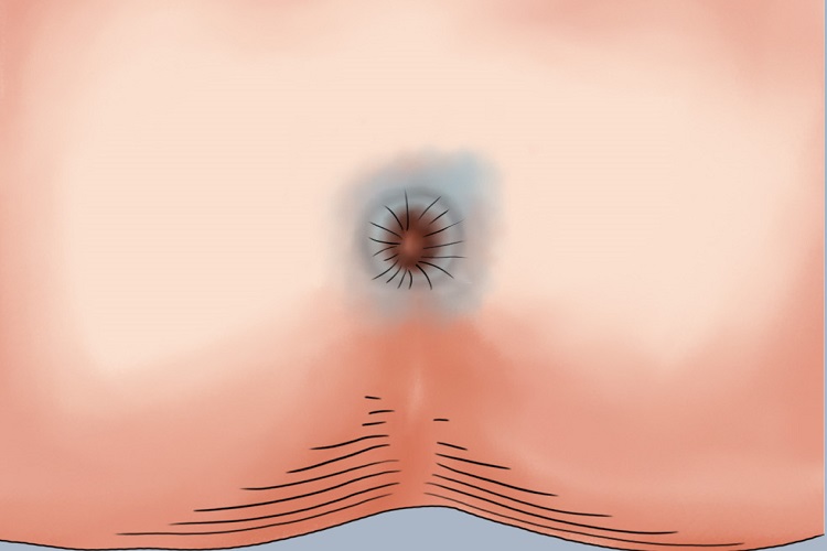 肛门黏膜白斑病肛周手绘图