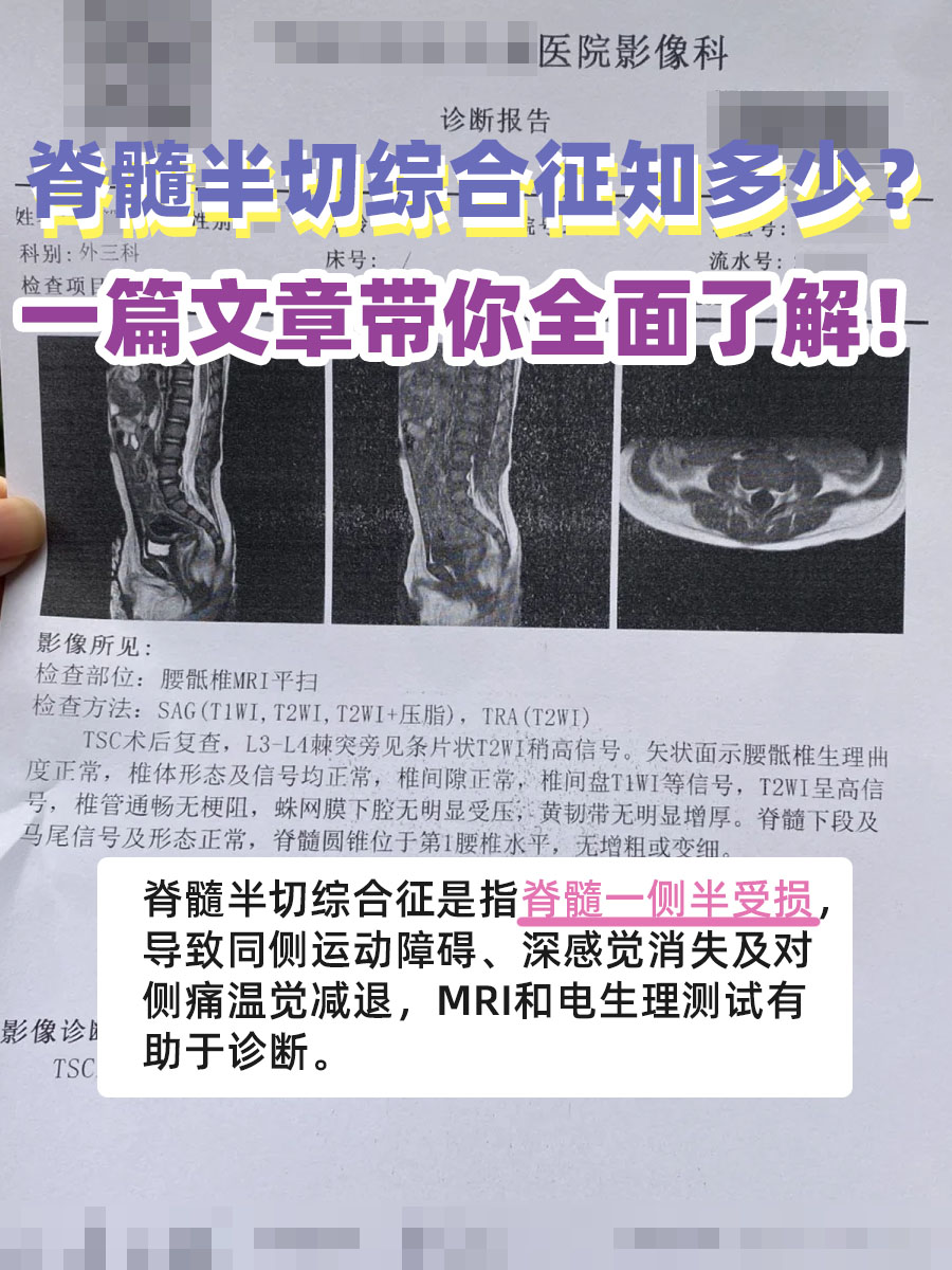 脊髓半切综合征知多少?一篇文章带你全面了解!