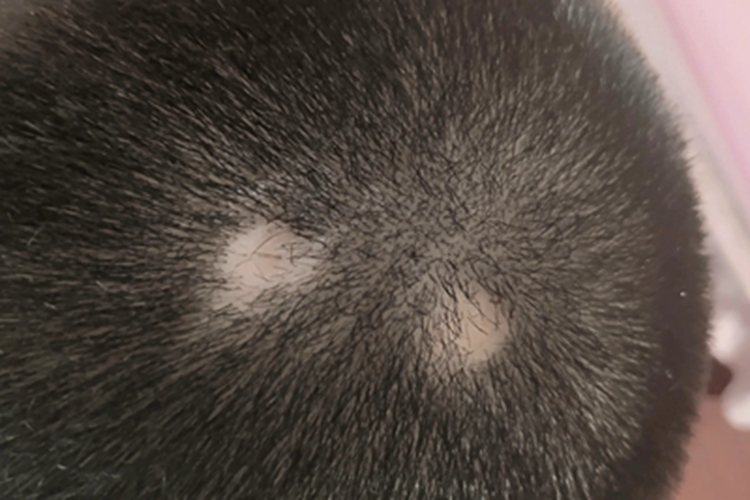 油风脱发头顶秃了两块图