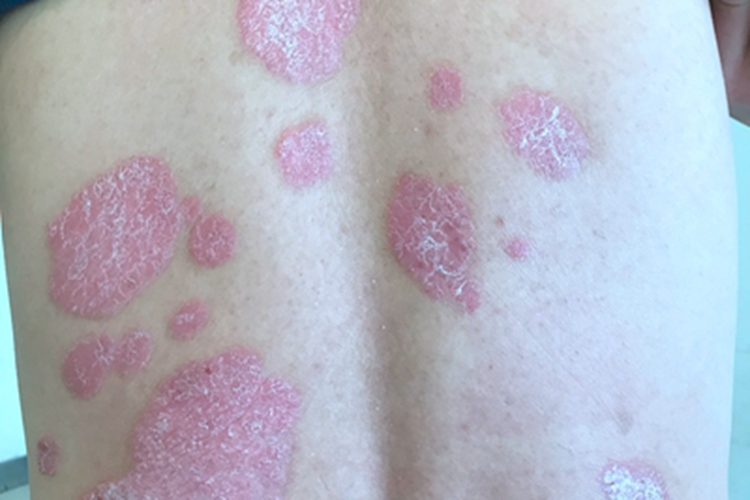 寻常型银屑病背部症状图