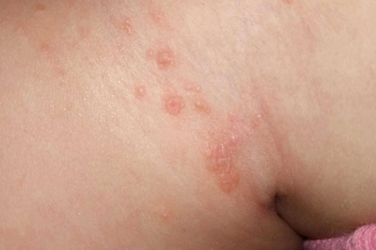 渗出型婴儿湿疹大腿小红疙瘩图 渗出型婴儿湿疹大腿小红疙瘩图