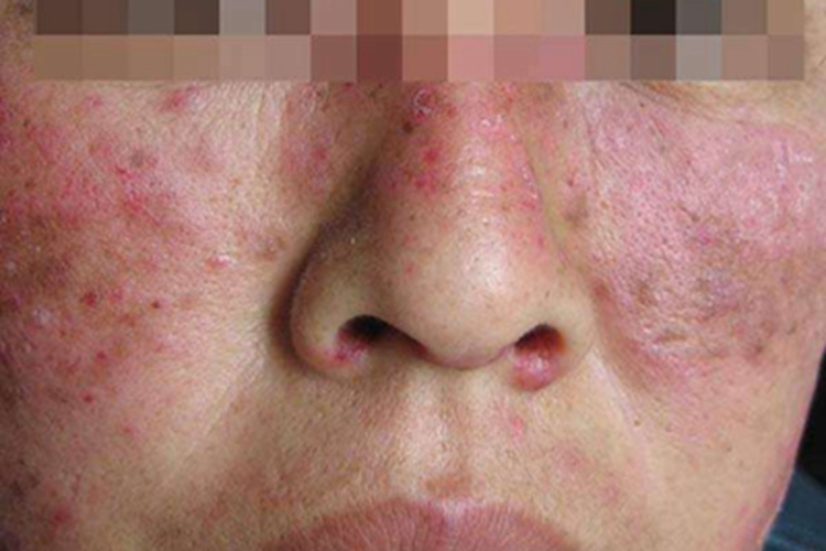 混合性结缔组织病丘疹图