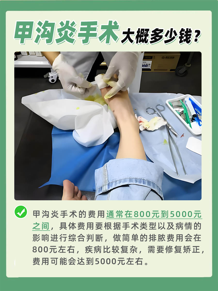 甲沟炎手术费用揭秘，多少钱？