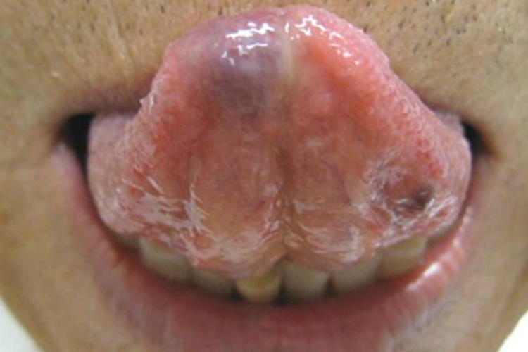 静脉湖瘤图 静脉湖瘤图