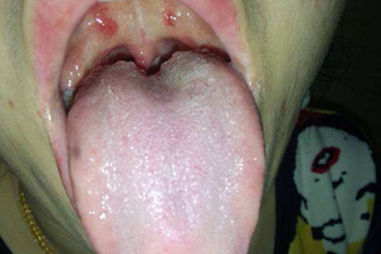 口腔黏膜结核性溃疡丘疹图 口腔黏膜结核性溃疡丘疹图