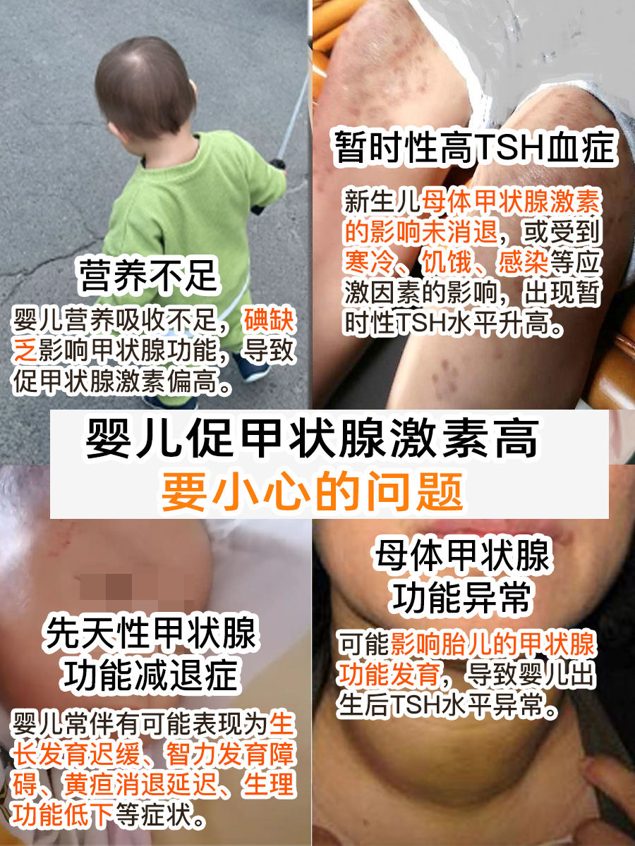 宝宝促甲状腺激素高，要小心这些问题！