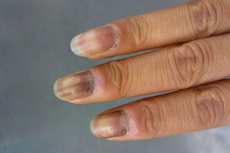 甲母痣图 甲母痣图