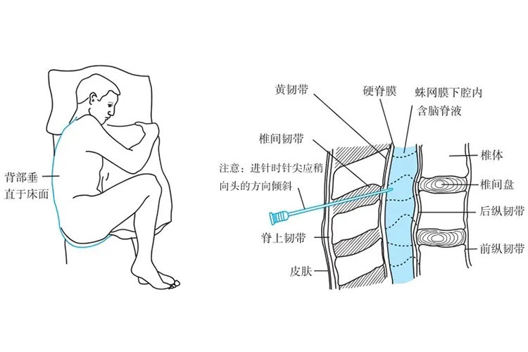 脑脊液穿刺部位矢状图