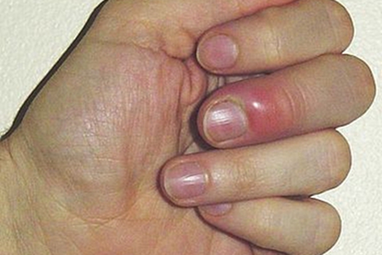 脓性指头炎手指红肿图