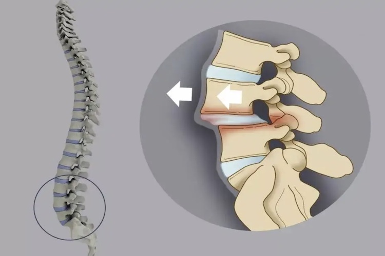 腰椎凹陷图 腰椎凹陷图