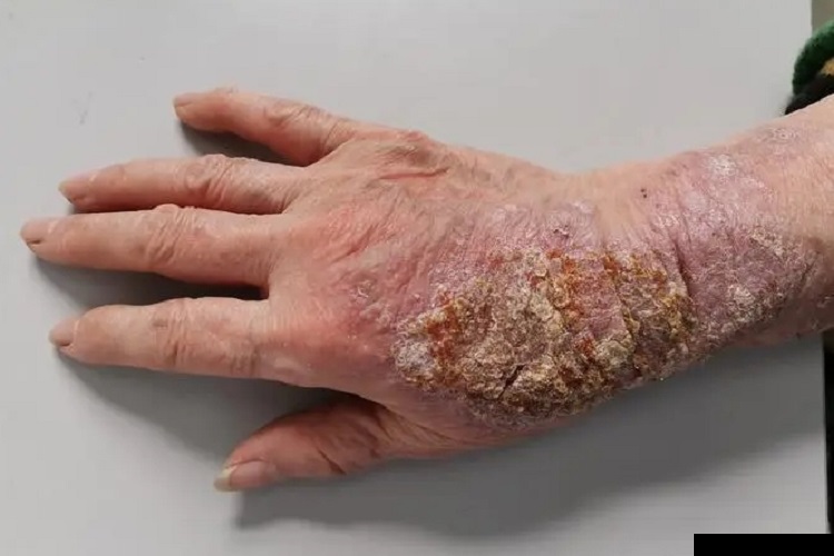 湿疹型多形性日光疹手腕糜烂图
