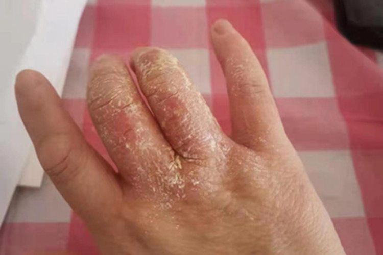 手部湿疹手指上有白色脱屑图