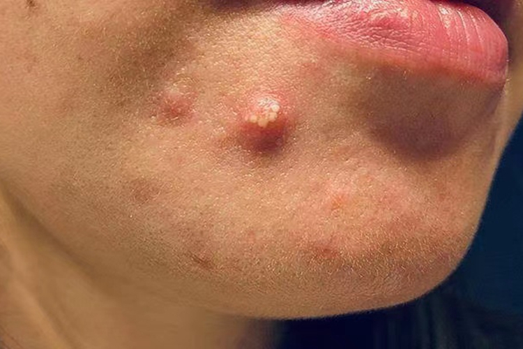 脓疱型痤疮图