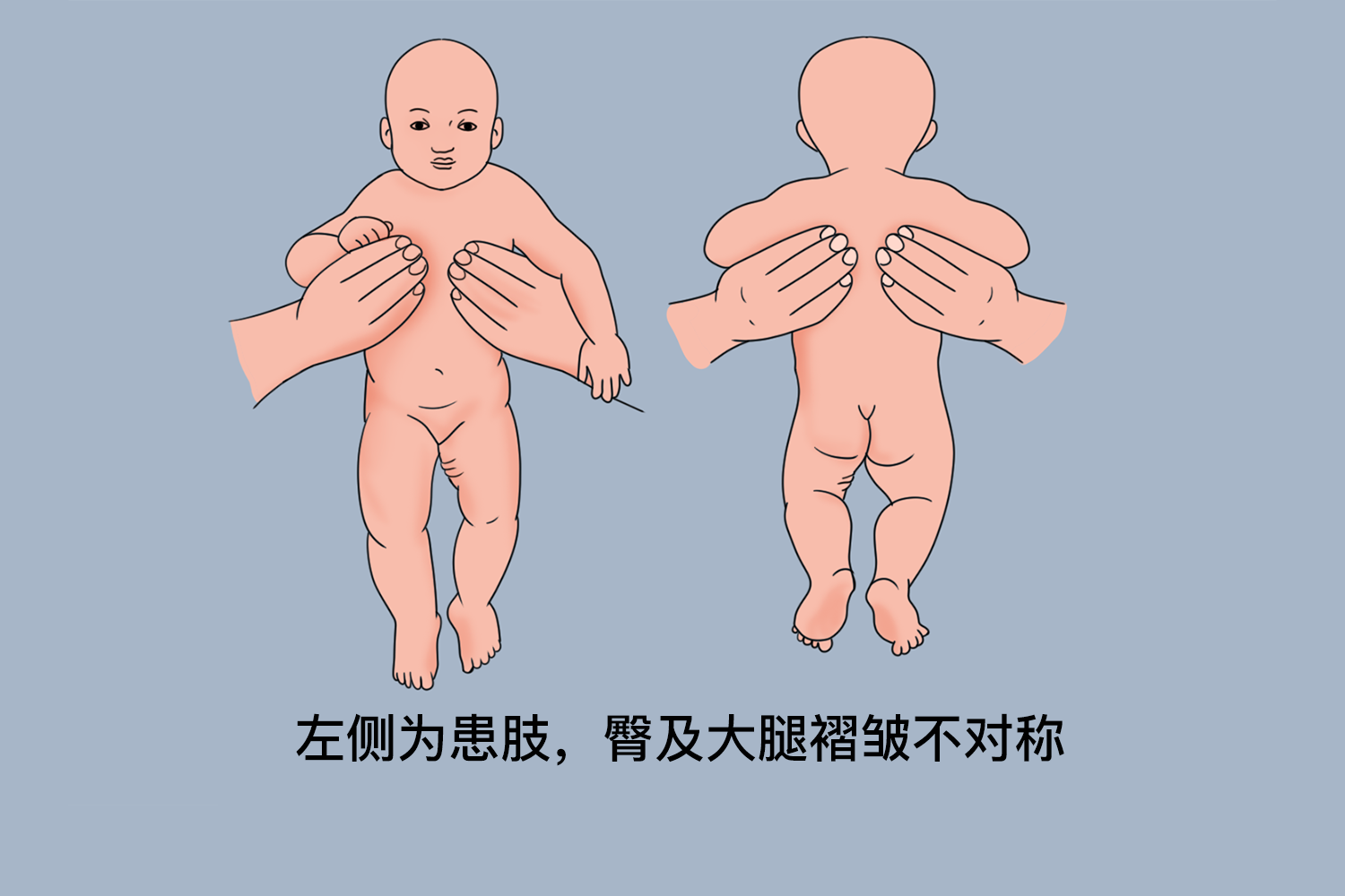 髋关节脱位婴儿皮肤图