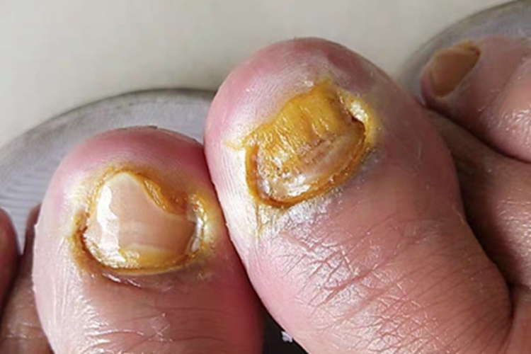 全甲损毁型甲真菌病脚趾甲图 全甲损毁型甲真菌病脚趾甲图