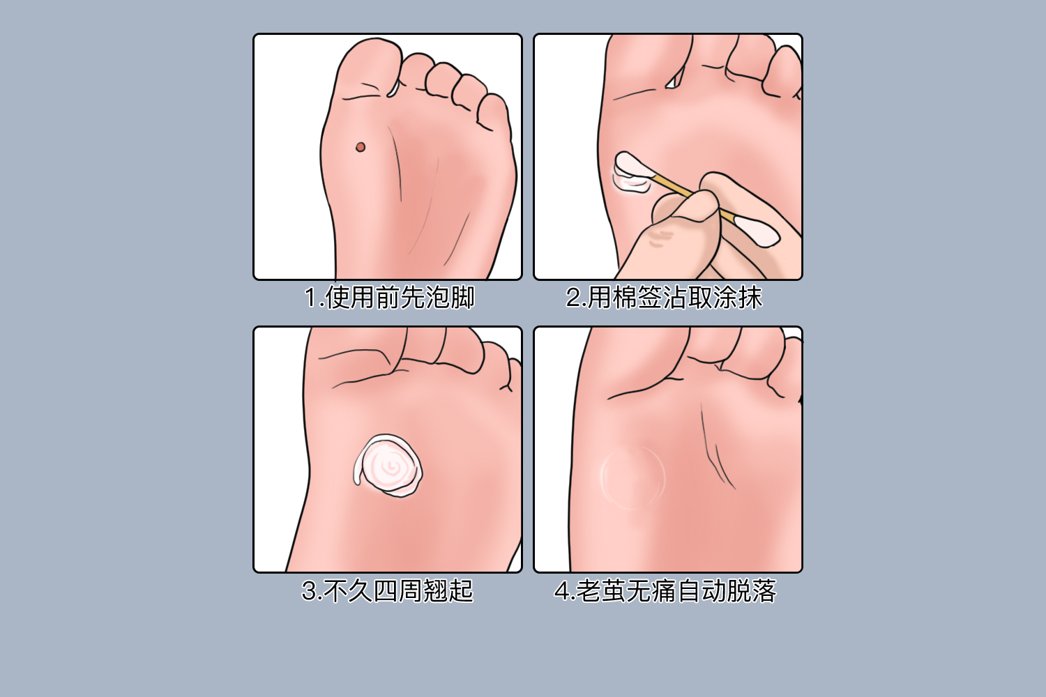 鸡眼膏治疗过程图