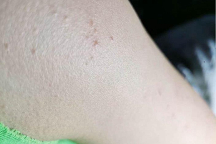 扁平疣肩部症状图