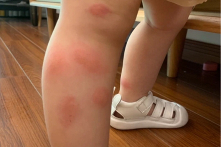 昆虫性皮炎小腿大红疙瘩图