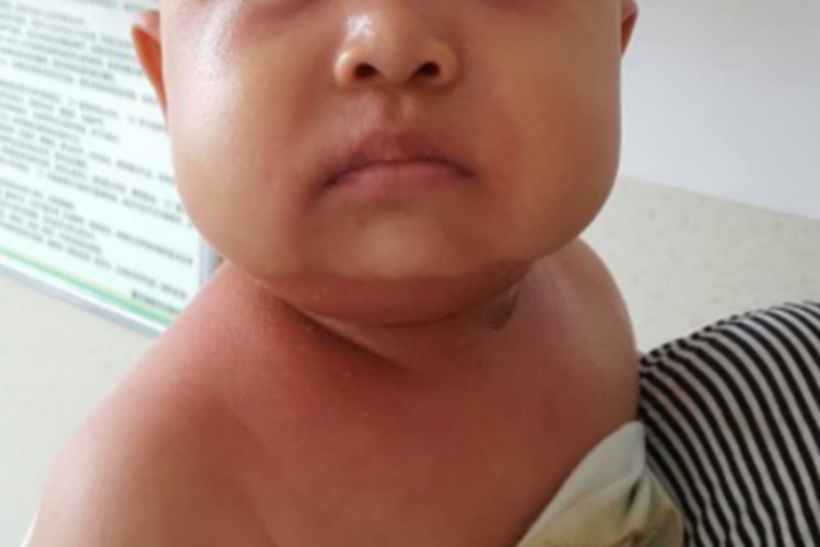 脓疱病前颈红肿图