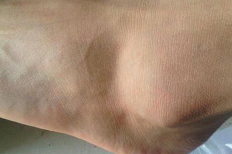 血友病A脚踝肿图 血友病A脚踝肿图