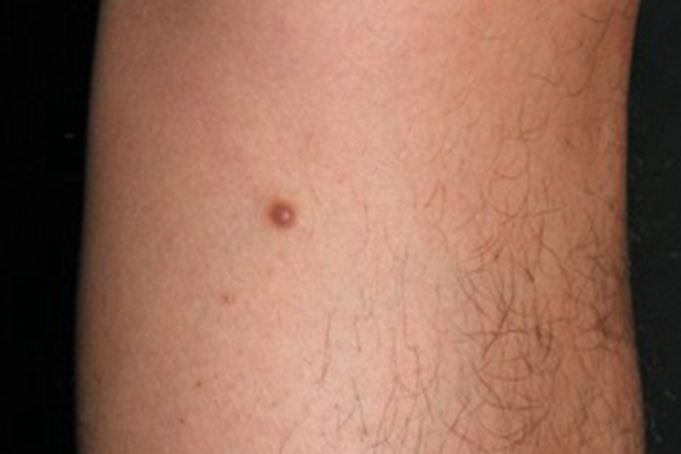 皮肤纤维瘤小腿结节图