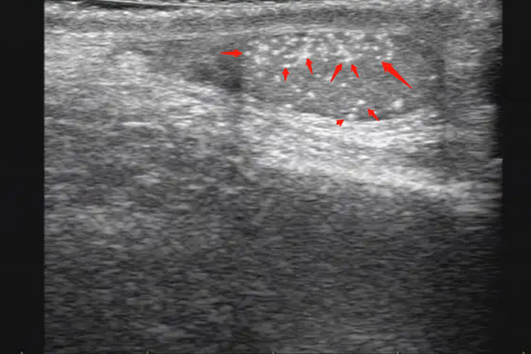 睾丸结石超声图 睾丸结石超声图