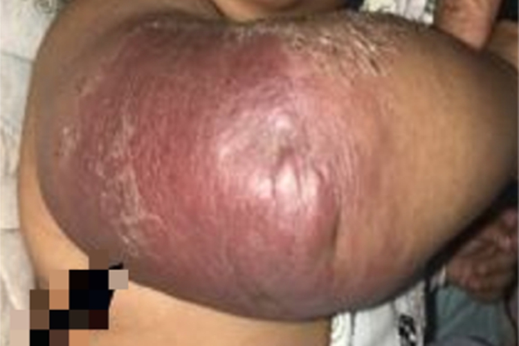 卡波西样血管内皮瘤胳膊紫斑图