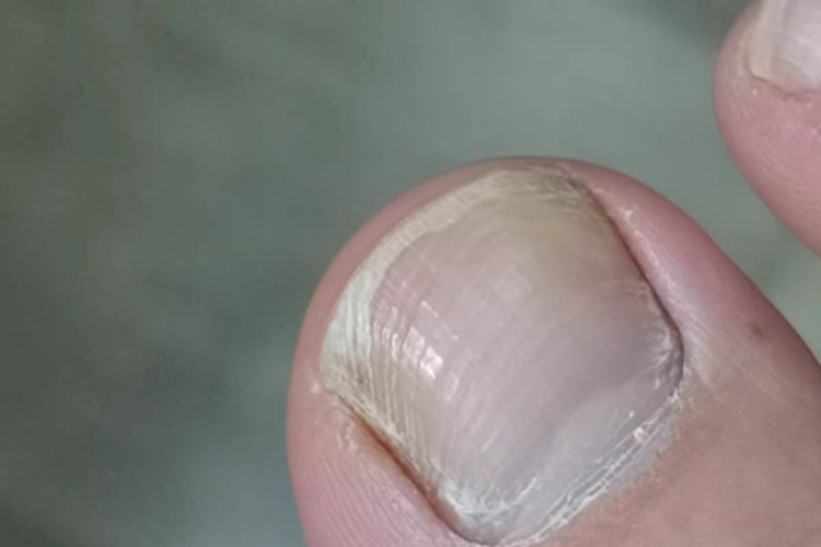 白色浅表型甲真菌病浑浊图 白色浅表型甲真菌病浑浊图