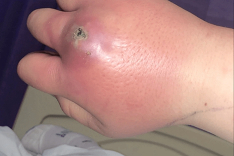 蜘蛛蜇伤红肿图