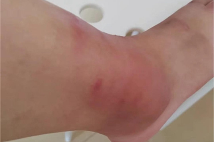 蚊虫叮咬脚踝红肿图 蚊虫叮咬脚踝红肿图